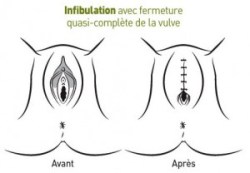 infibulation-1-300x208